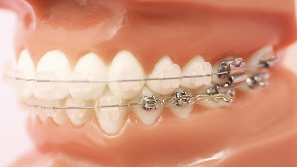 恵庭市の矯正歯科