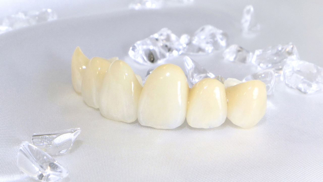 恵庭市の審美歯科(白い詰め物・被せ物)
