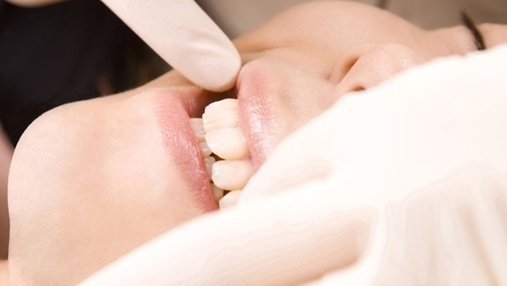 恵庭市のホワイトニング