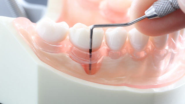 恵庭市の歯周病の治療