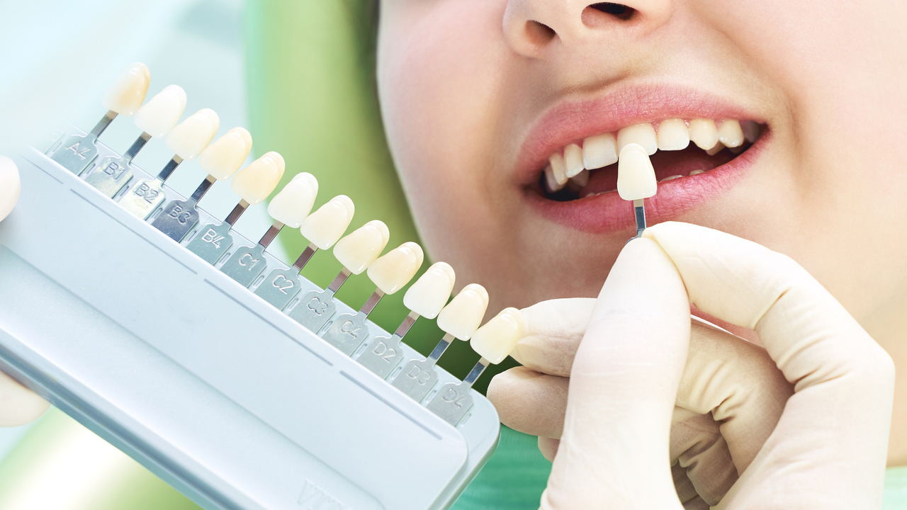 恵庭市のホワイトニング