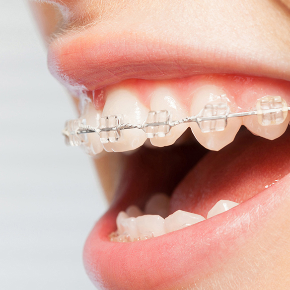 恵庭市の矯正歯科