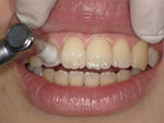 ３.歯のクリーニング